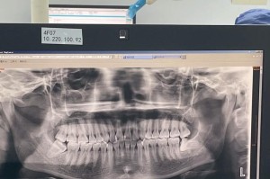 智齿不疼不拔，会产生哪些影响？（保留智齿的利与弊）
